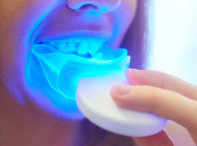 Professional Teeth Whitening Adelaide