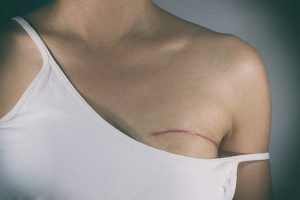 Central-Surgery breast reduction Adelaide